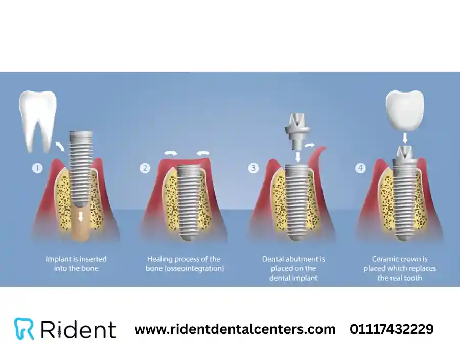 خطوات زراعة الأسنان من مركز Rident ونتيجة مذهلة
